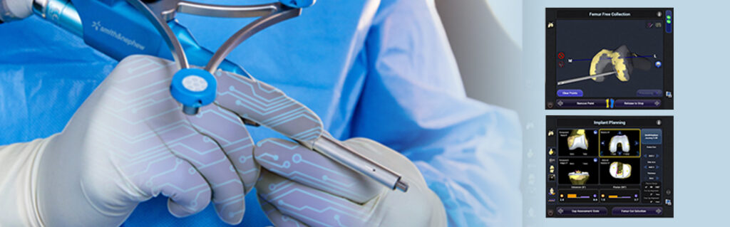 Robotik Cerrahi ile Diz Protezi Ameliyati 2