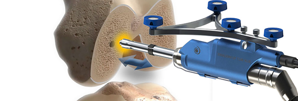 Robotik diz protezi ameliyati nedir 1