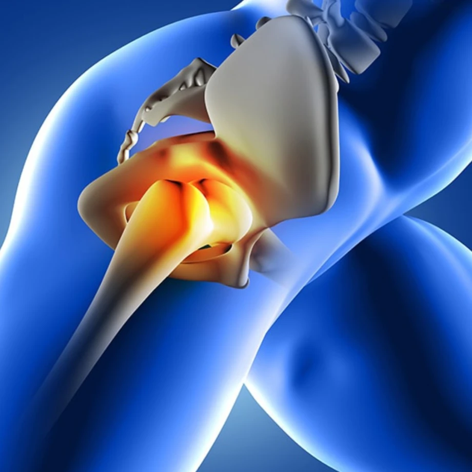 Kalça Protezi Ameliyatı Nedir? Nasıl Yapılır? 4 kalca-akseki