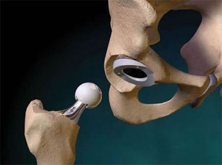 Kalça Protezi Ameliyatı Nedir? Nasıl Yapılır? 3 kalca devrim