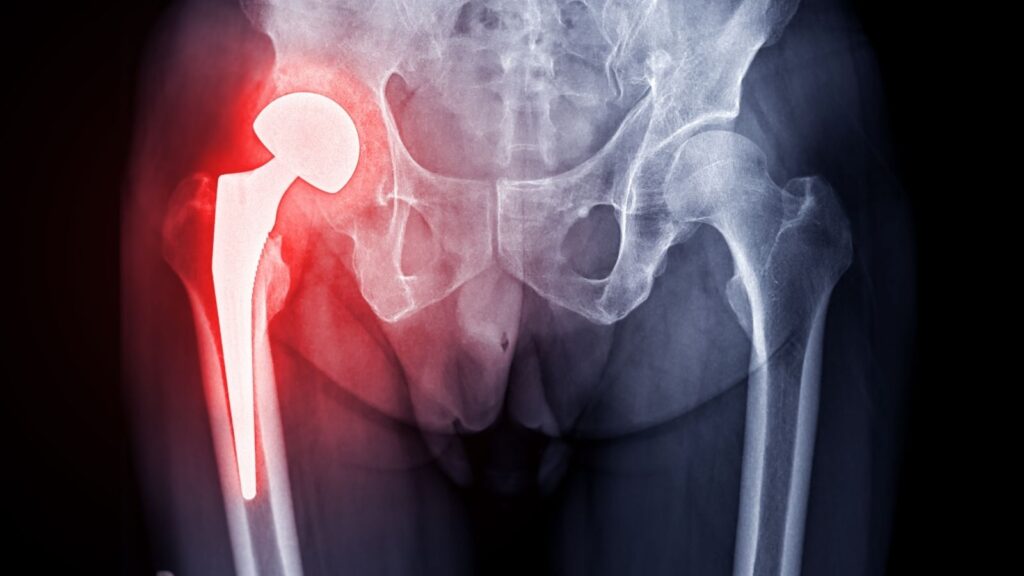 Kalça Protezi Ameliyatı Nedir? Nasıl Yapılır? 2 kalca-protezi