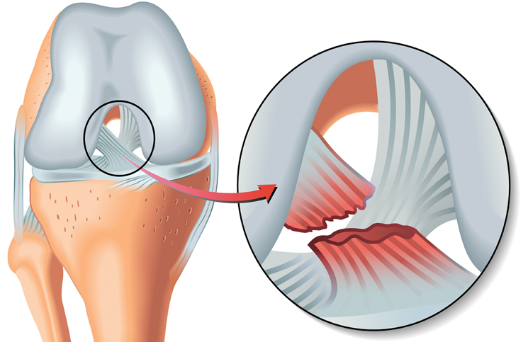Menisküs Ameliyatı Nedir? Menisküs Ameliyatı Kaç Günde İyileşir? 2 meniskus-ameliyati