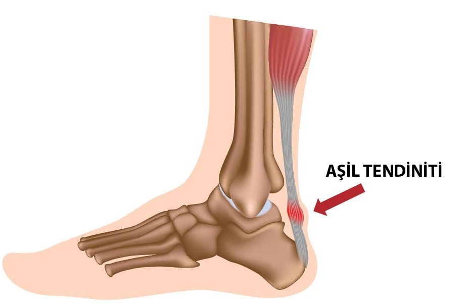 asil-tendon